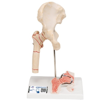 3B Scientific Hip Model with Femoral Fracture and Osteoarthritis (Right)